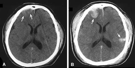 TJ. Concussion & contusion | Concussions, X ray, Brain