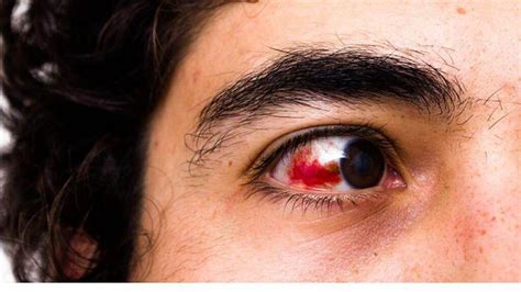 19 Reasons For Having Red Eyes | Bloodshot Eyes Causes