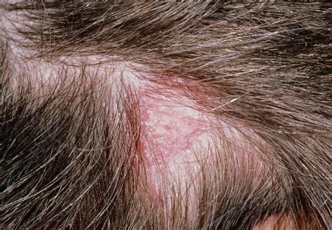 Tinea capitis: ringworm of the scalp (lesion) - Stock Image M270/0155 ...