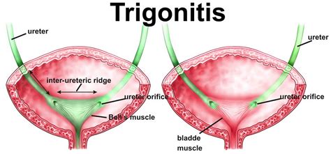 Trigonitis causes, symptoms, diagnosis, treatment & prognosis