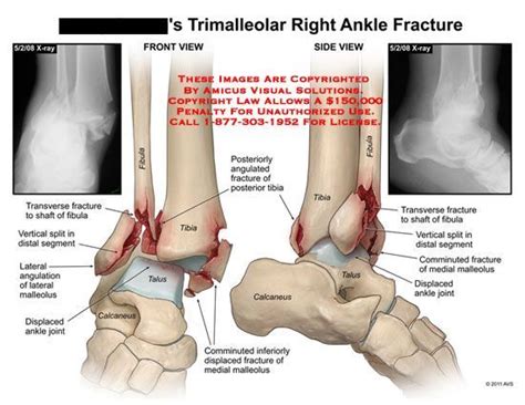 Trimalleolar Ankle Fracture | Ankle fracture, Broken ankle recovery ...