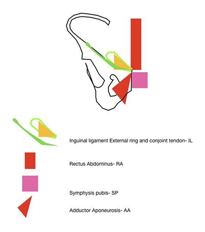 Sportsmans Groin: The Inguinal Ligament and the Lloyd Technique | Journal of the Belgian Society ...