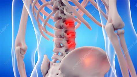 Painful lumbar spine, illustration - Stock Image - F034/9752 - Science Photo Library