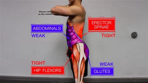 How to Fix Anterior Pelvic Tilt in 4 Simple Steps (Daily... | Pelvic tilt, Good back workouts ...