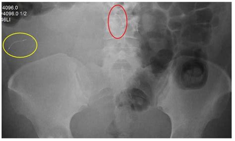 How far can Essure coils migrate through the body? Abdomen Uterus Cervix