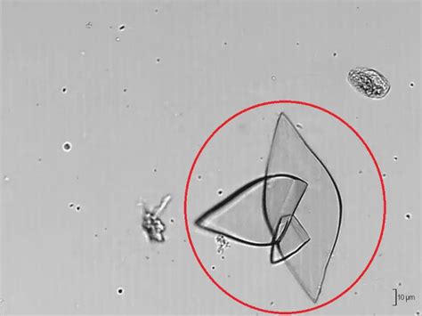 Types of Crystals Found In Human Urine and Their Clinical Significance - Laboratoryinfo.com