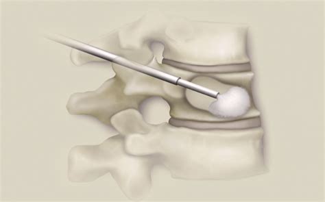 Balloon Kyphoplasty London UK | Vertebroplasty London UK