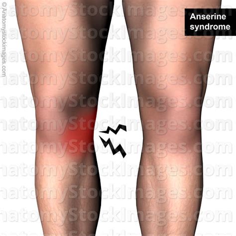 Anatomy Stock Images Knee Anserine Syndrome Pes Anserinus Bursitis ...