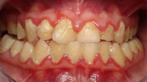 Plaque and your teeth - Waverley Oaks Dental | Gum disease, Healthy teeth, Dental