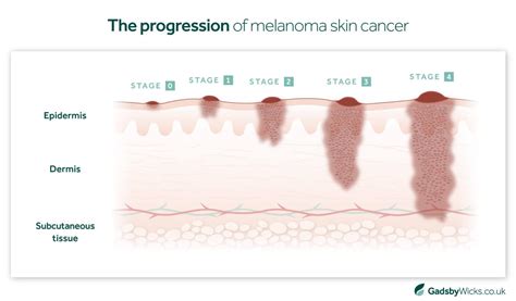 Melanoma Skin Cancer Stages