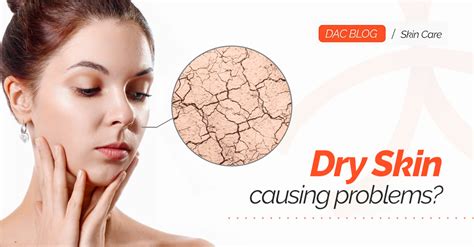 Dry Skin causing problems?