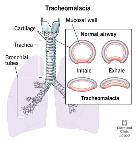 Tracheomalacia: Symptoms, Causes & Treatment