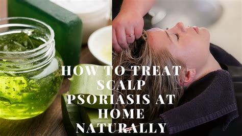 Treating scalp psoriasis at home naturally fast {Home Remedies} - YouTube