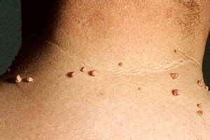 Warts on Face: All Possible Locations, Their Causes, and Effective Treatment - Med Warts