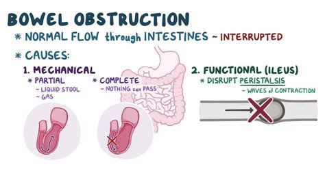 Bowel obstruction: Video, Anatomy & Definition | Osmosis