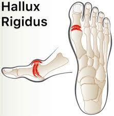 Hallux rigidus : Cause, Symptoms, Diagnosis, Treatment,Exercise | Mobile