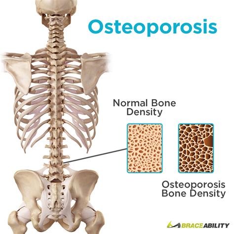 TLSO Braces | Thoracolumbosacral Thoracic Lumbar Sacral Orthosis