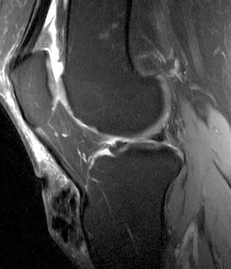 Pretibial Bursitis