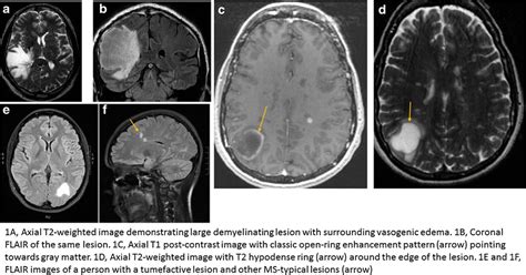 Common MRI features of tumefactive demyelinating lesions. a Axial... | Download Scientific Diagram