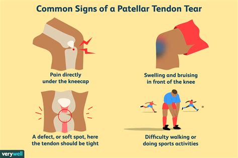 Patellar Tendon Tear Causes, Diagnosis, and Treatment