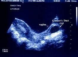 Gartner Cyst Ultrasound