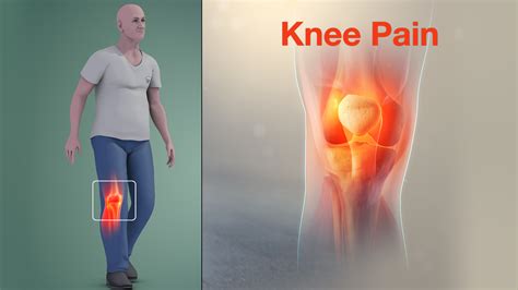 Knee Pain Causes Signs Symptoms Diagnosis And Treatment Hot Sex Picture ...