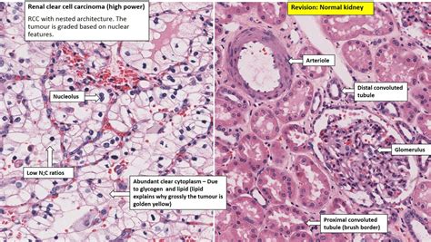 Kidney – Renal Cell Carcinoma – NUS Pathweb :: NUS Pathweb