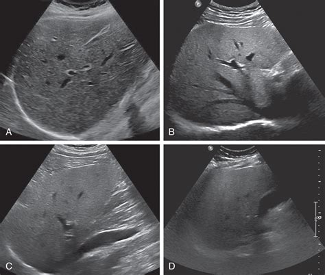 Normal Vs Fatty Liver Ultrasound