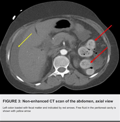 Ct Scan Abdomen Labeled | SexiezPix Web Porn