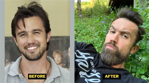 Rob McElhenney Plastic Surgery. Weight Loss And Health Update.