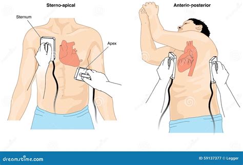 Defibrillator Cartoons, Illustrations & Vector Stock Images - 1528 Pictures to download from ...