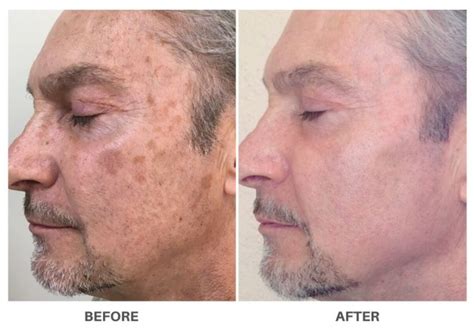 LASER SKIN RESURFACING | FOR YOUNGER, HEALTHIER SKIN