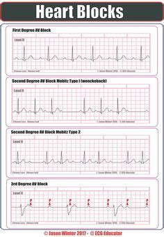 Junctional Rhythms | Heart blocks, Ekg interpretation, Ekg