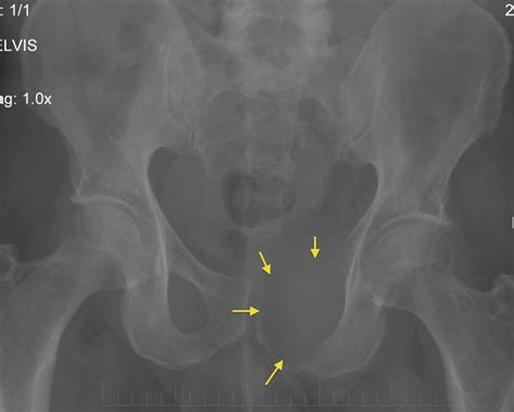 Lytic bone metastasis - Radiology at St. Vincent's University Hospital