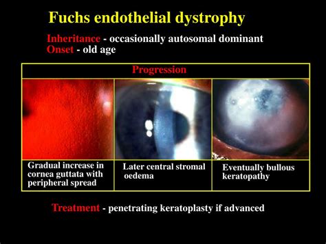 PPT - CORNEAL DYSTROPHIES PowerPoint Presentation - ID:735456