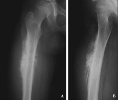 Osteogenic Sarcoma Sunburst