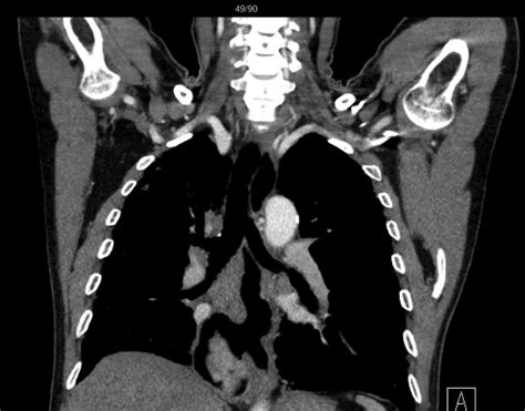 A large 8 7-cm epiphrenic diverticulum. | Download Scientific Diagram