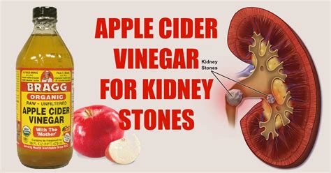 5 Ways To Use Apple Cider Vinegar To Dissolve Kidney Stones