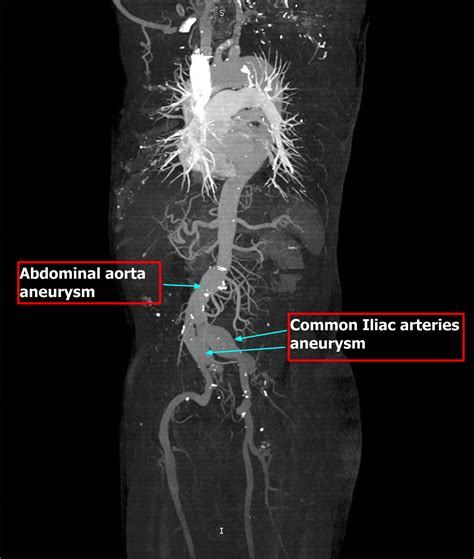 Aorta Artery Aneurysm