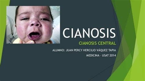 Cianosis central - Fisiopatología