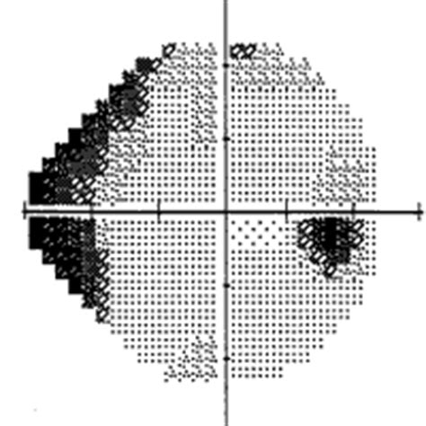 Visual Field Damage in Glaucoma - Glaucoma & Cataract, Prof. Eytan ...