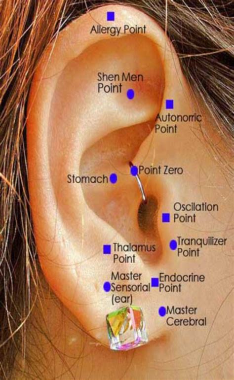 Acupuncture For Ear Ringing / Ear Acupuncture 耳针 - Proacupuncture - Procedures carried out ...