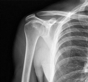 Findings at the time of Shoulder Surgery that can determine Rotator ...