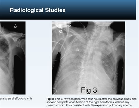 Figure 1 from Re-Expansion Pulmonary Edema | Semantic Scholar