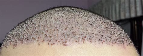 Hair Transplant Infections - causes, risks, treatment explained by a ...