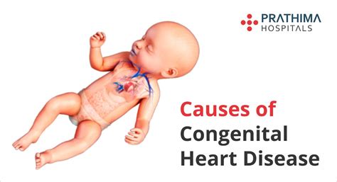 Know About Congenital Heart Disease | Prathima hospitals