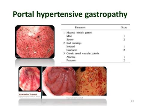 Portal hypertension and gastrointestinal bleeding