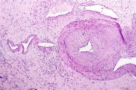 Cholecystitis Histology