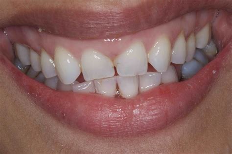 Before and After Dental Bonding Photos | Cosmetic Bonding Dentists