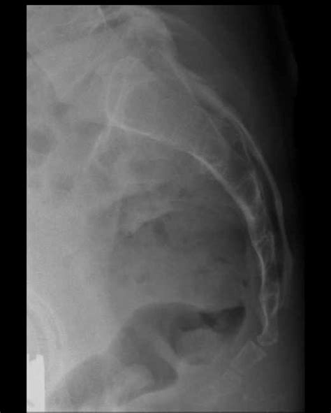 Sacrum Anatomy Xray